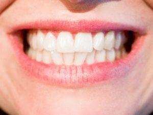 Full Set of Teeth Smile - Superior Smiles