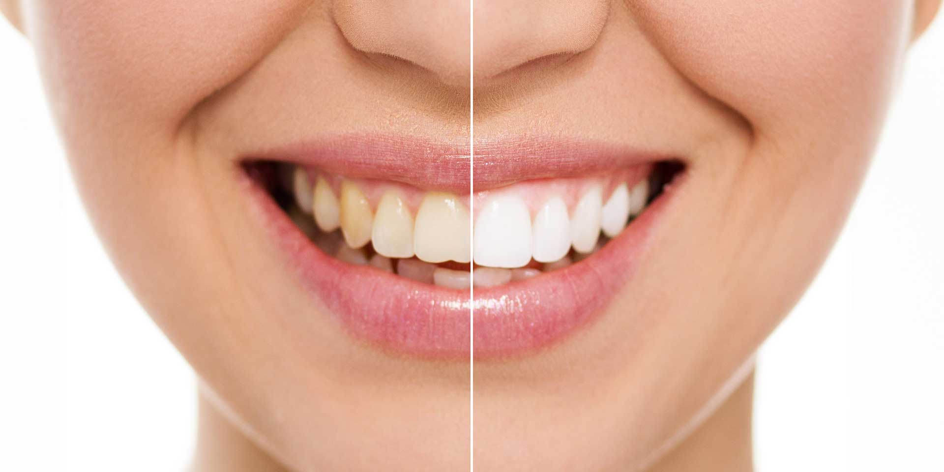 Philips Zoom teeth whitening Fremantle dental clinic Perth white teeth comparison