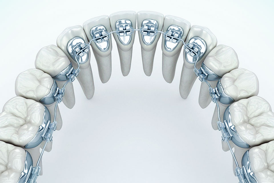 Lingual Braces Perth orthodontics dental clinic Fremantle Hilton metal braces inside lower teeth 3D illustration