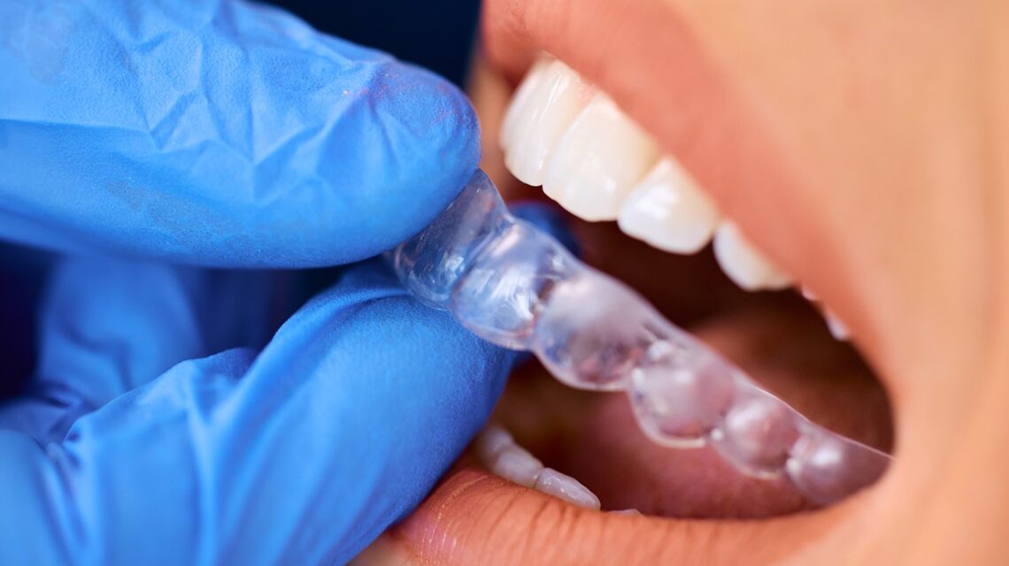 Close up of dentist placing invisible dental aligners on woman's teeth