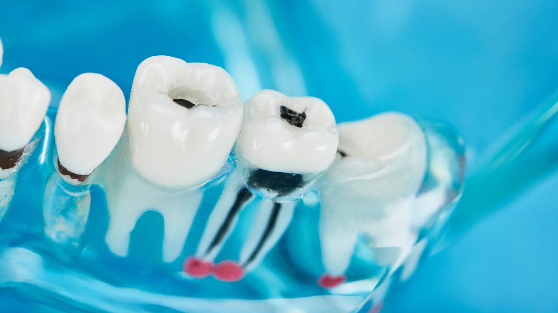 selective focus of teeth model with dental caries in white teeth on blue