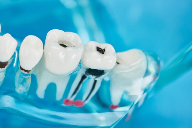 selective focus of teeth model with dental caries in white teeth on blue